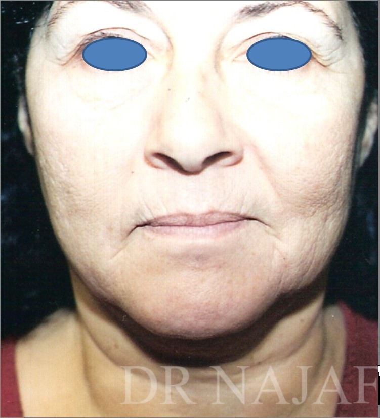 Facelift before and after - before