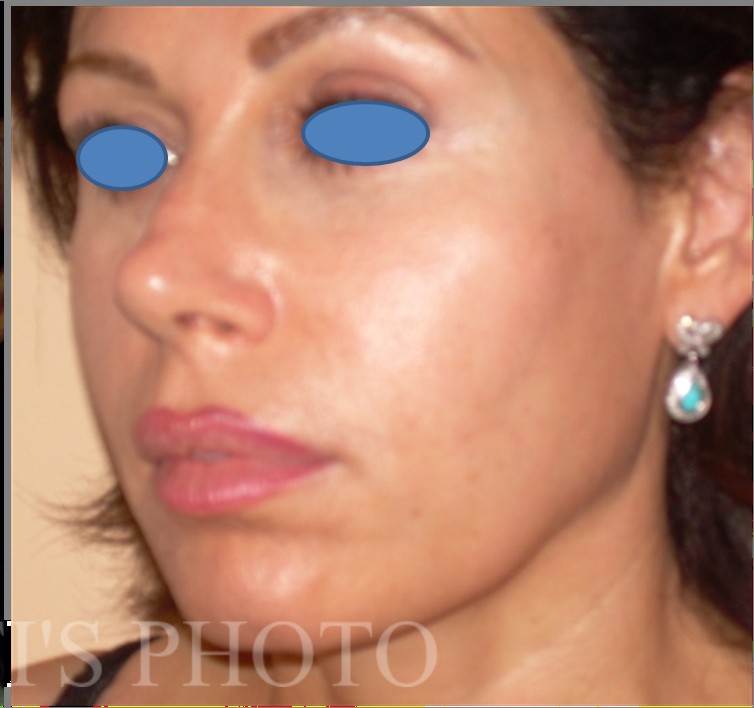 Facelift before and after - after
