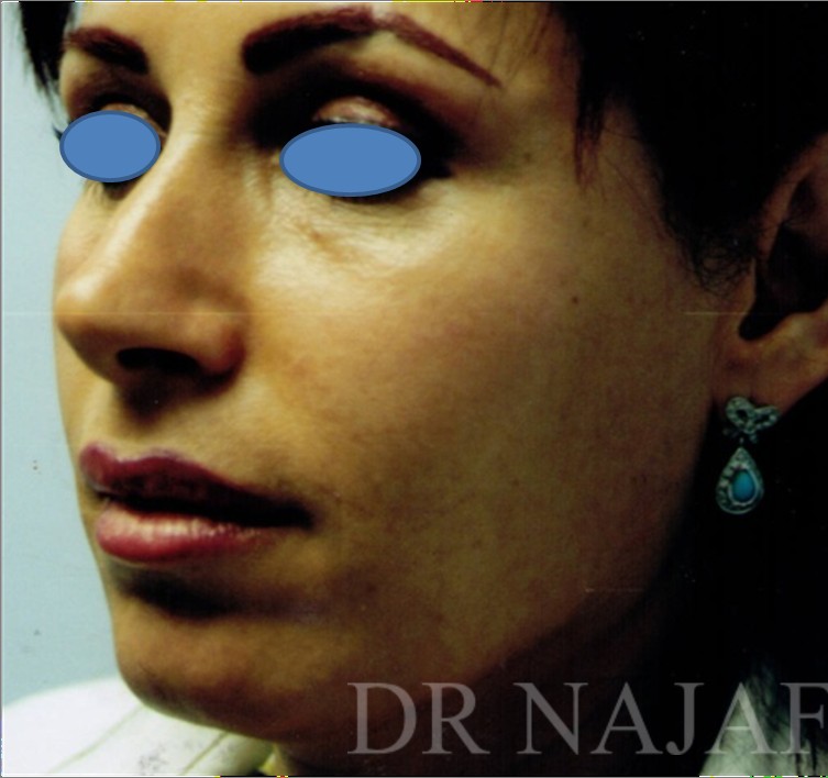 Facelift before and after - before