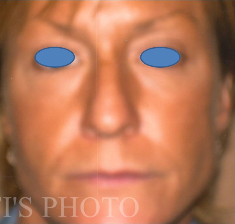 Facelift before and after - after