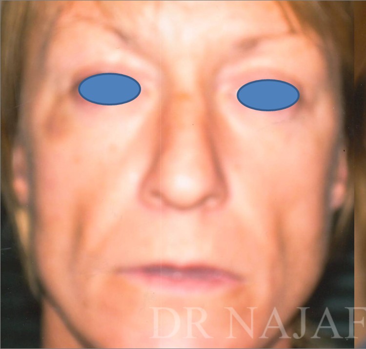 Facelift before and after - before