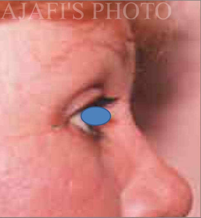 Blepharoplasty before and after - after