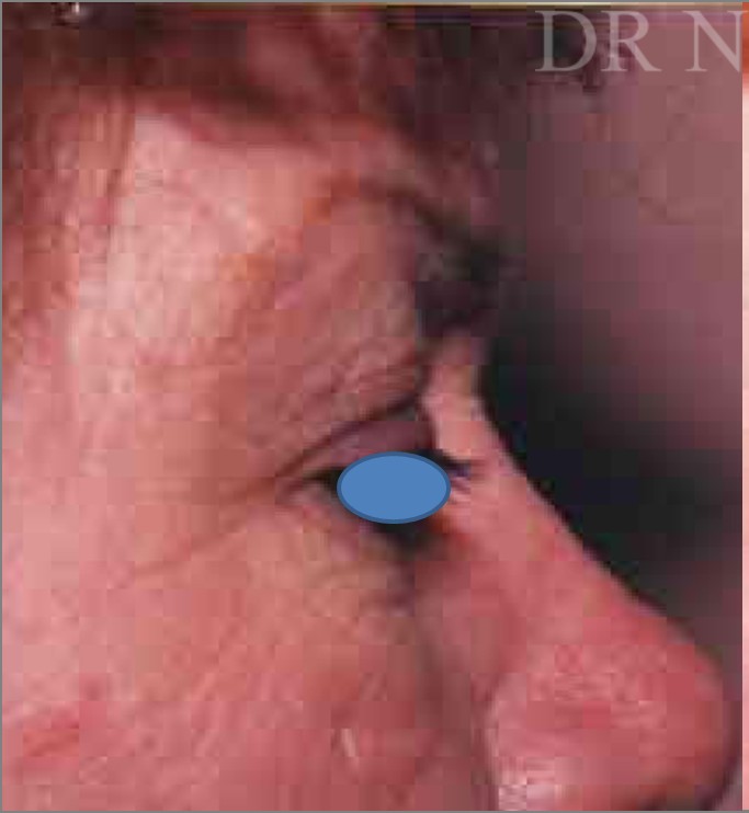 Blepharoplasty before and after - before