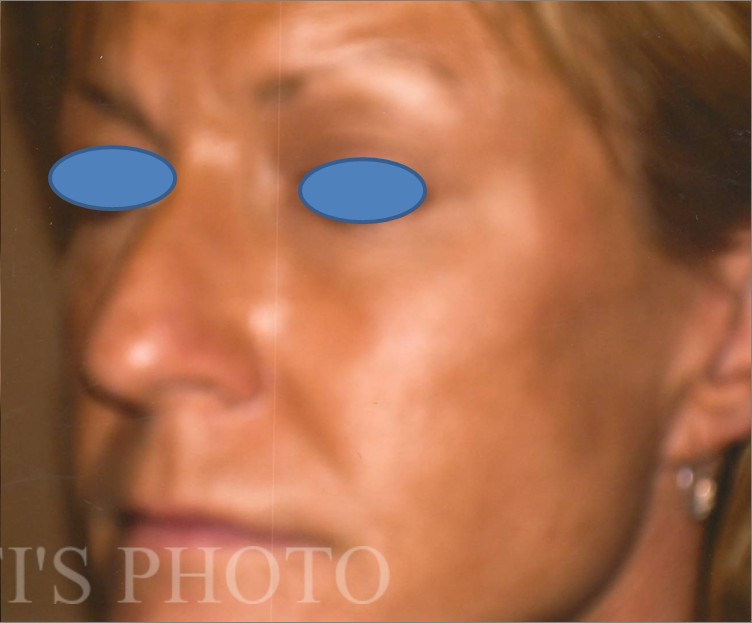 Facelift before and after - after