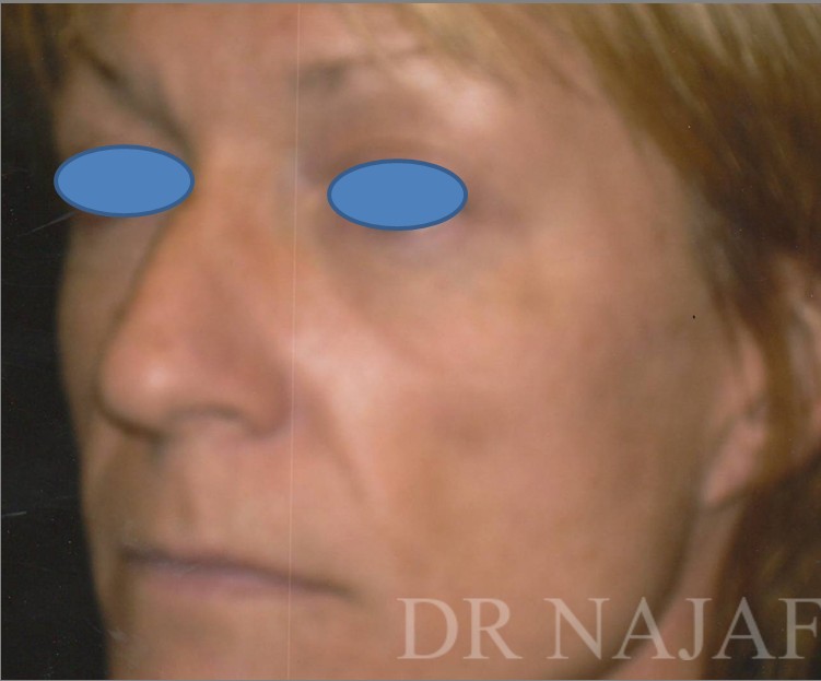Facelift before and after - before