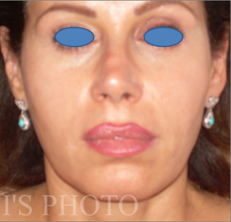 Facelift before and after - after