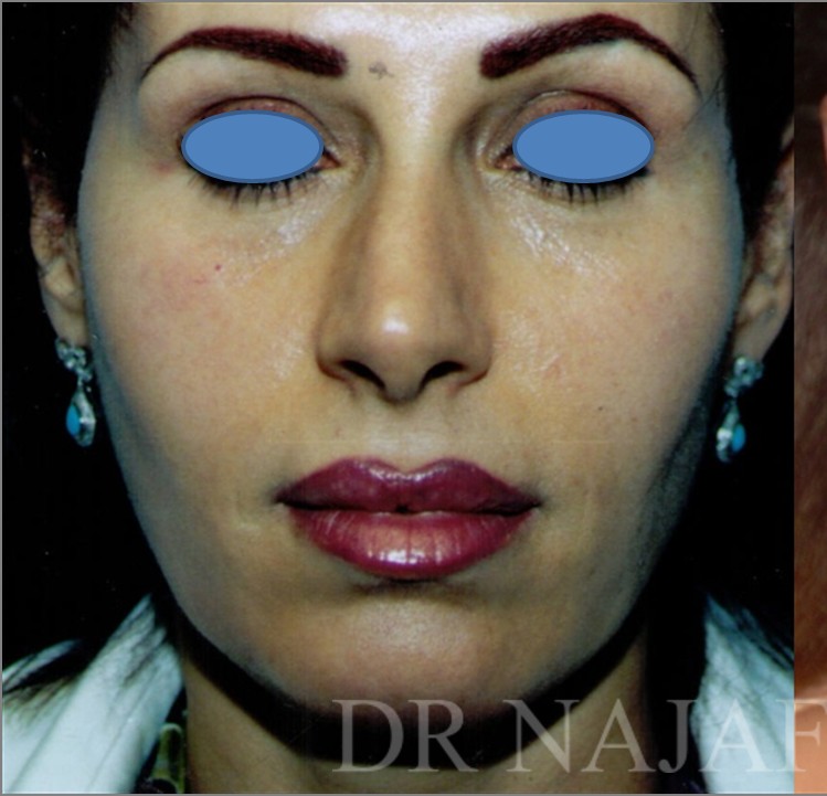 Facelift before and after - before