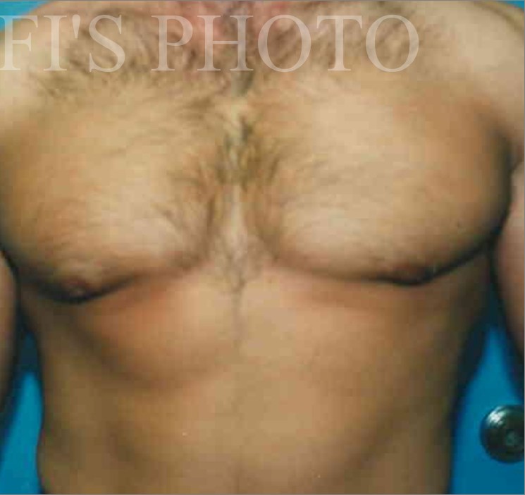 Liposuction before and after - after