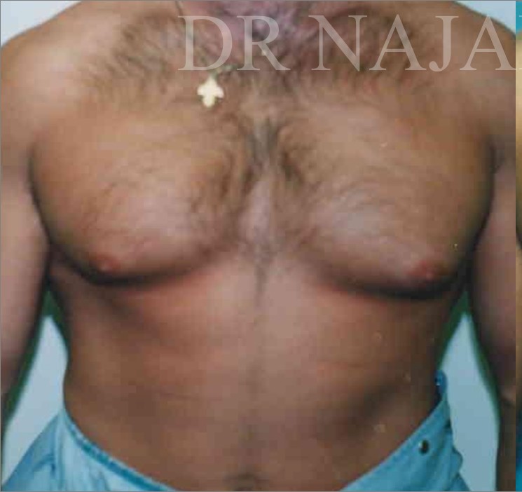 Liposuction before and after - before