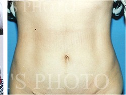 Liposuction before and after - after
