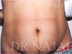 Liposuction before and after - before