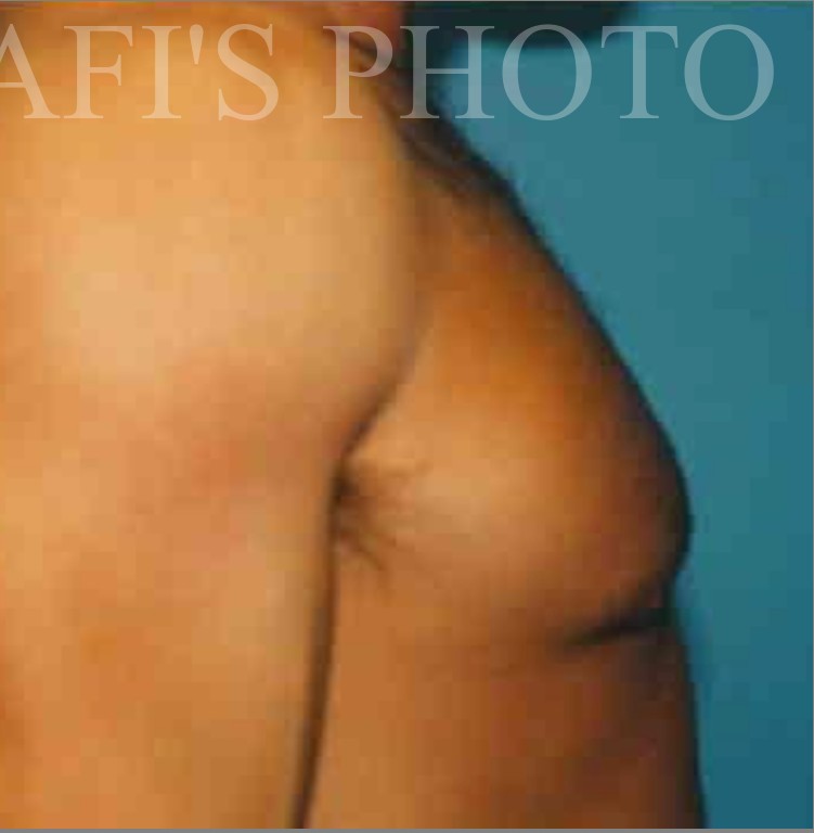 Liposuction before and after - after