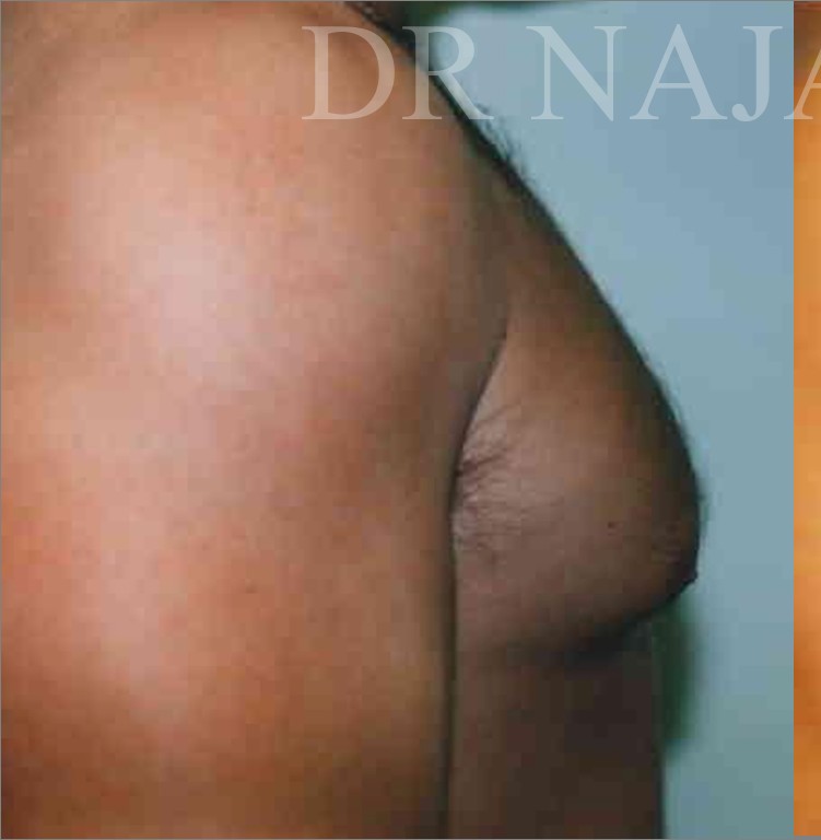 Liposuction before and after - before