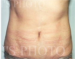 Liposuction before and after - after