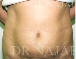 Liposuction before and after - before