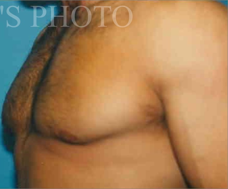 Liposuction before and after - after