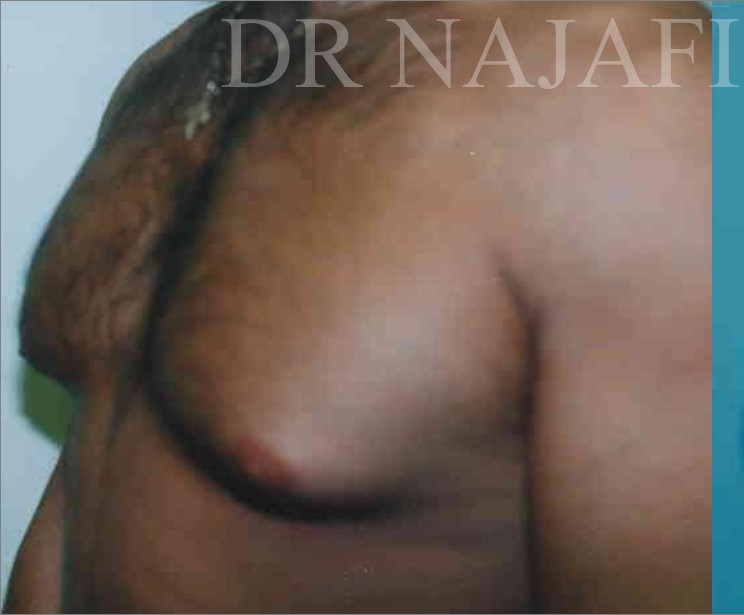 Liposuction before and after - before
