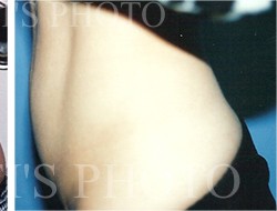 Liposuction before and after - after