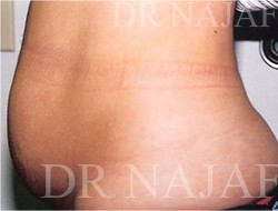 Liposuction before and after - before