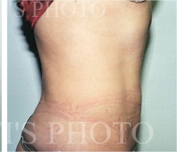 Liposuction before and after - after