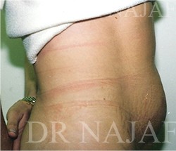 Liposuction before and after - before