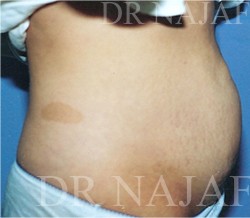 Liposuction before and after - before