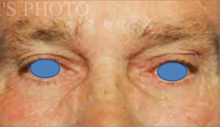 Blepharoplasty before and after - after