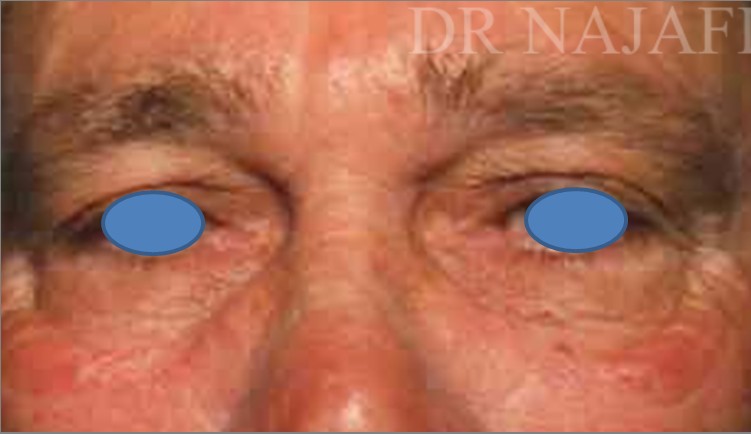 Blepharoplasty before and after - before