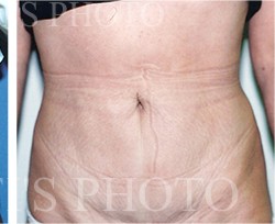 Liposuction before and after - after