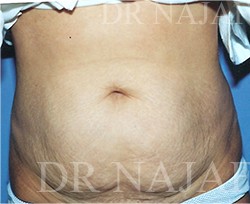 Liposuction before and after - before