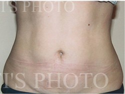 Liposuction before and after - after