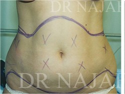 Liposuction before and after - before