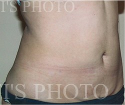 Liposuction before and after - after