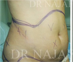 Liposuction before and after - before