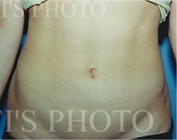 Liposuction before and after - after