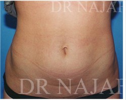 Liposuction before and after - before