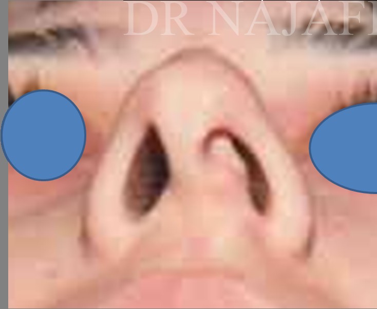 Rhinoplasty before — Dr. Hossein Najafi