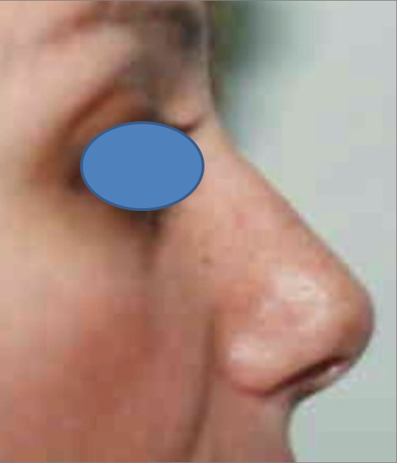 Rhinoplasty after — Dr. Hossein Najafi