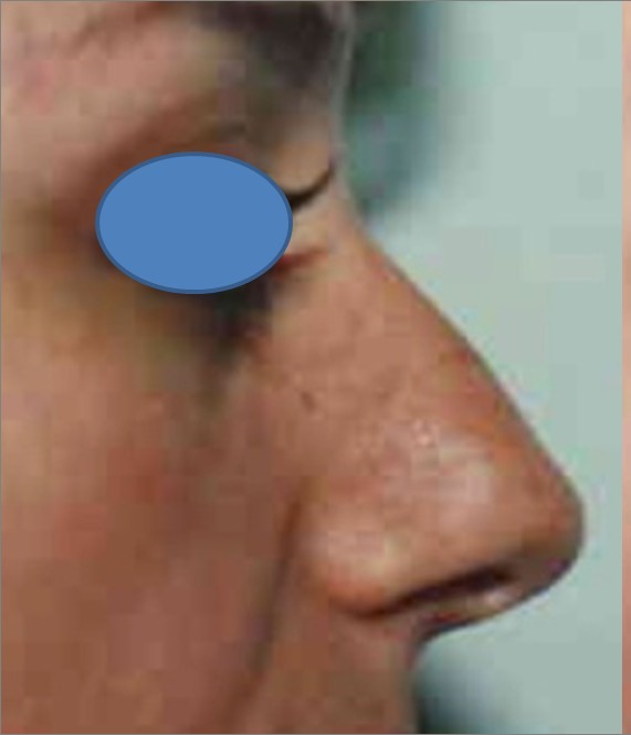 Rhinoplasty before — Dr. Hossein Najafi