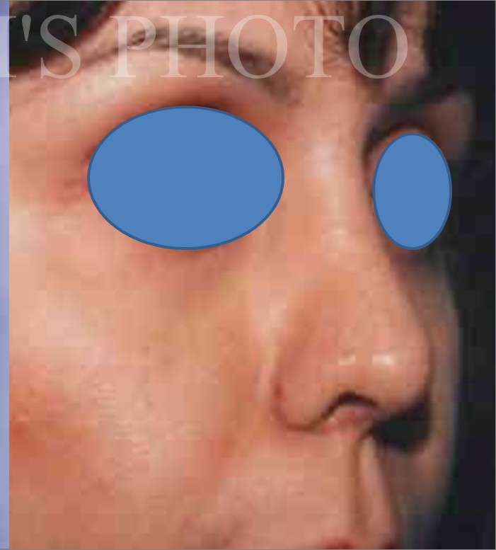 Rhinoplasty after — Dr. Hossein Najafi