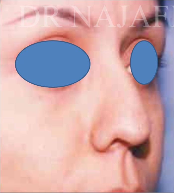 Rhinoplasty before — Dr. Hossein Najafi
