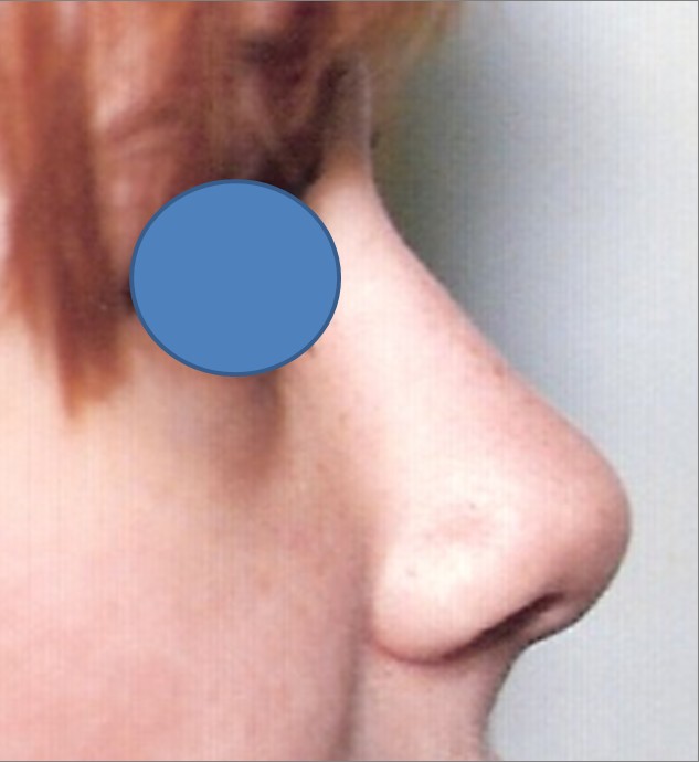 Rhinoplasty after — Dr. Hossein Najafi