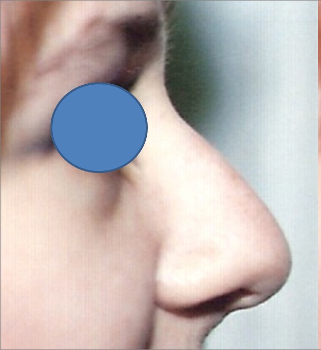 Rhinoplasty before — Dr. Hossein Najafi