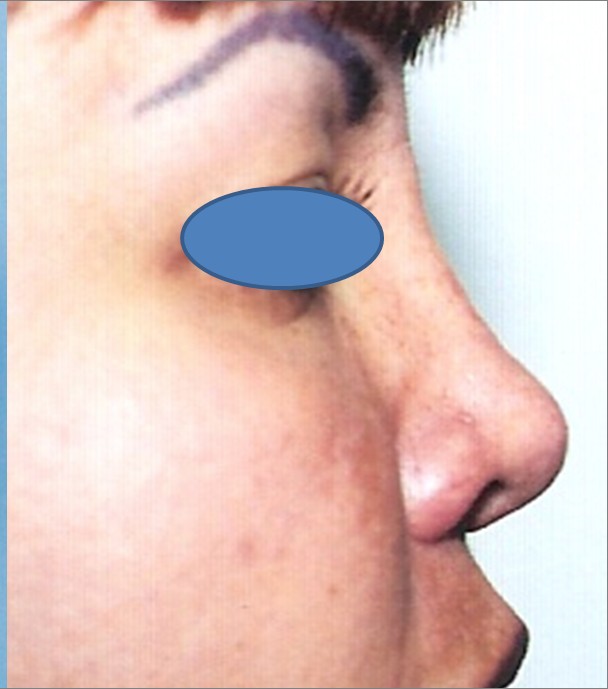 Rhinoplasty after — Dr. Hossein Najafi