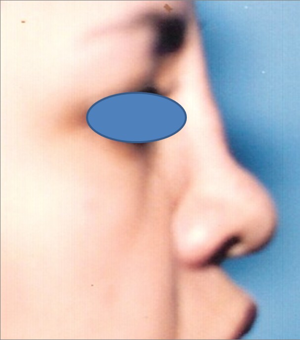 Rhinoplasty before — Dr. Hossein Najafi