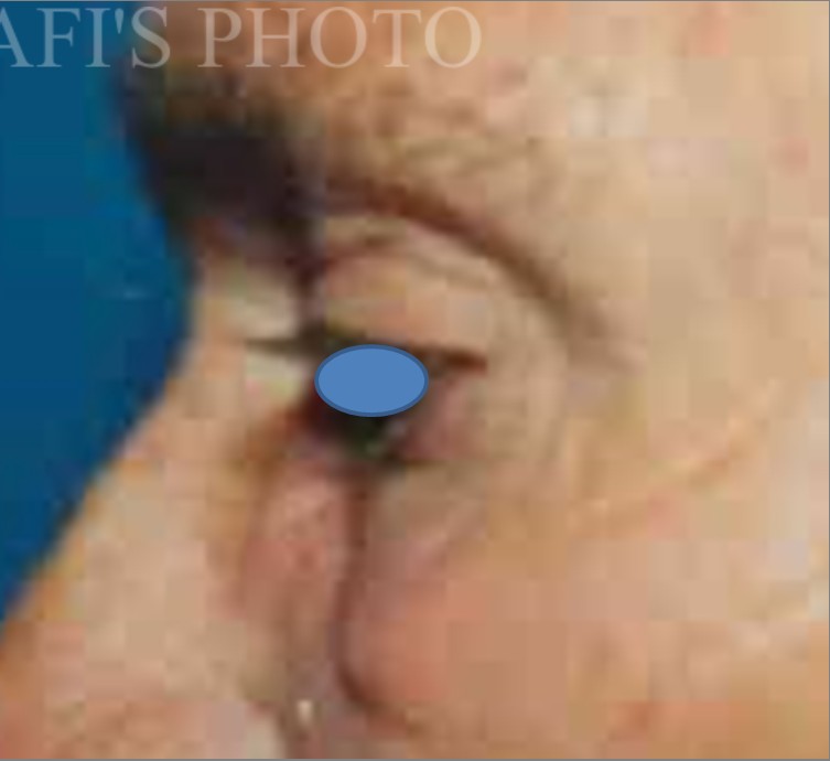 Blepharoplasty before and after - after