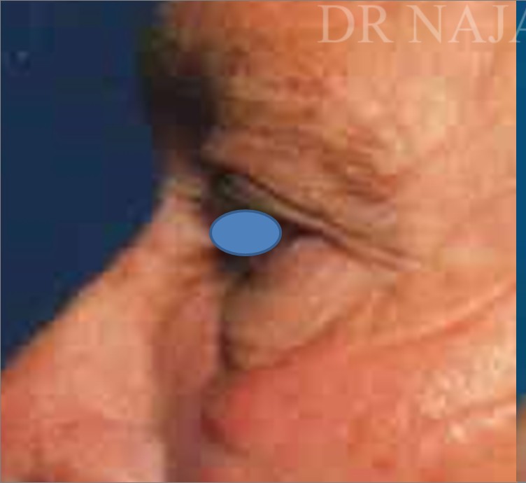 Blepharoplasty before and after - before