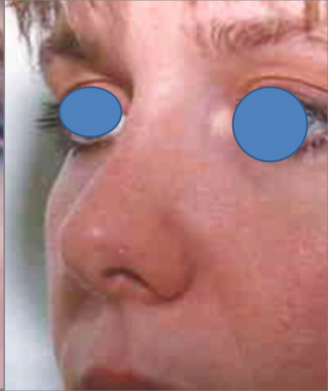 Rhinoplasty after — Dr. Hossein Najafi