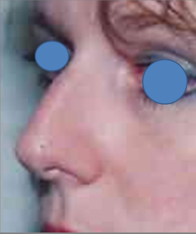 Rhinoplasty before — Dr. Hossein Najafi