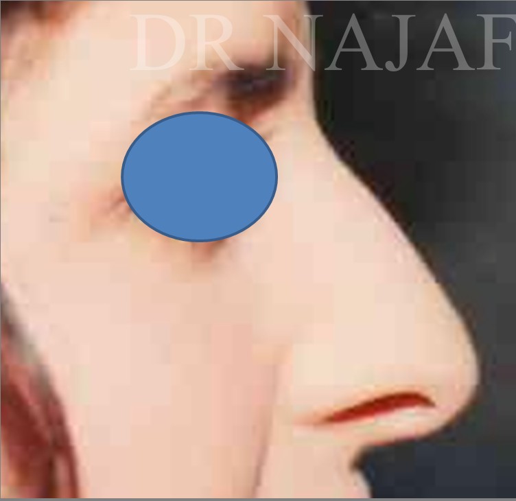 Rhinoplasty before — Dr. Hossein Najafi